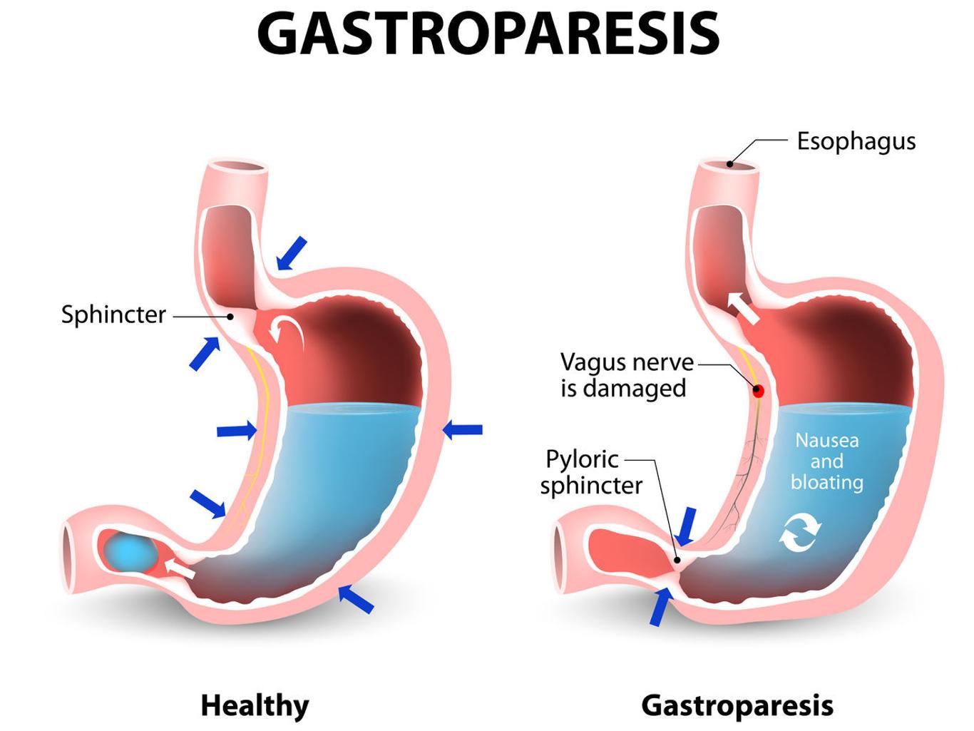 Visual comparison of healthy gastric and stomach with Gastroparesis.
