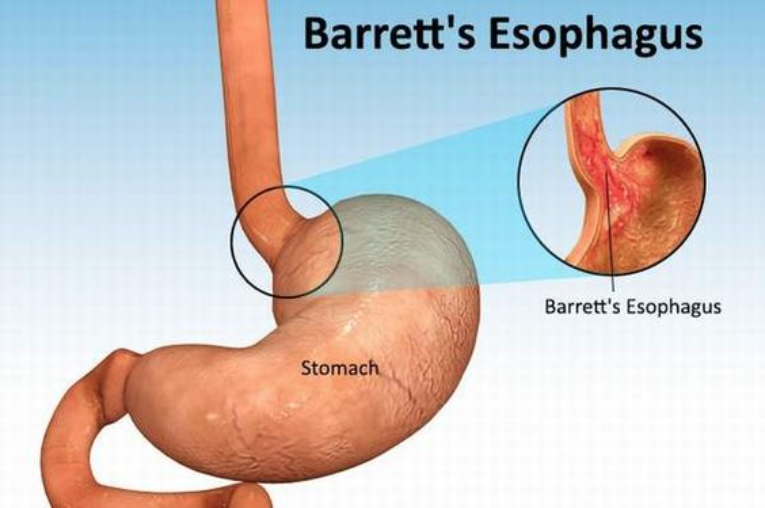 Barrett's Esophagus Cross Section